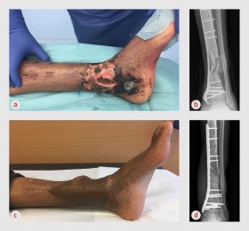 Richtlijn Fractuur-gerelateerde infecties