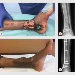 Richtlijn Fractuur-gerelateerde infecties